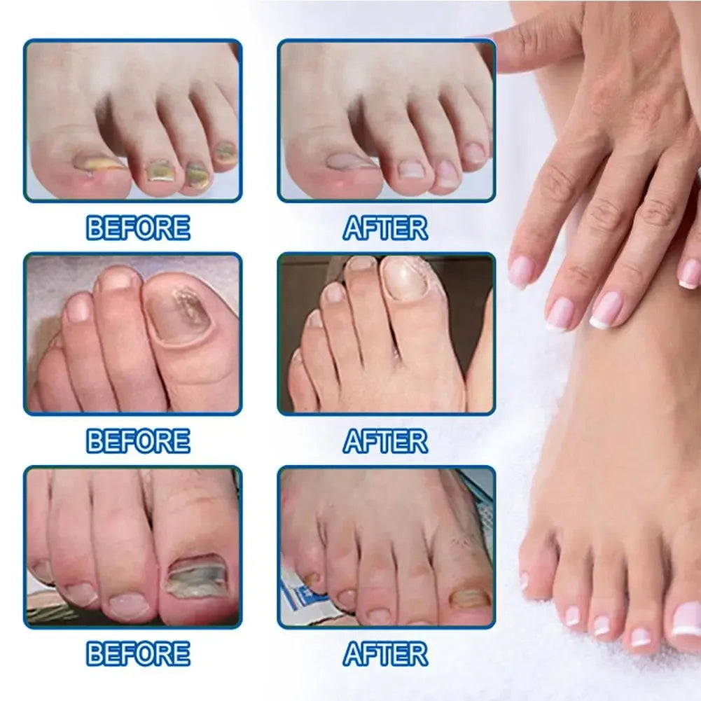 Adesivos de Reparação Discretos para Unhas com Fungos — foto 5